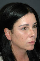 Mid Facelift - Patient 1 - Obl Right - After